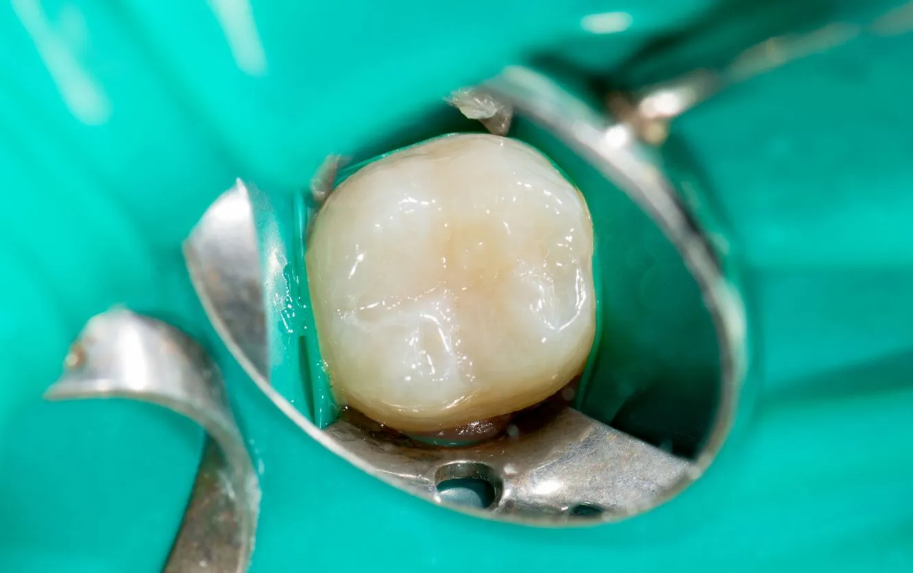 Close-up view of a dental dam isolating a molar with visible decay during a cavity preparation, emphasizing precision and moisture control during restorative dental treatments
