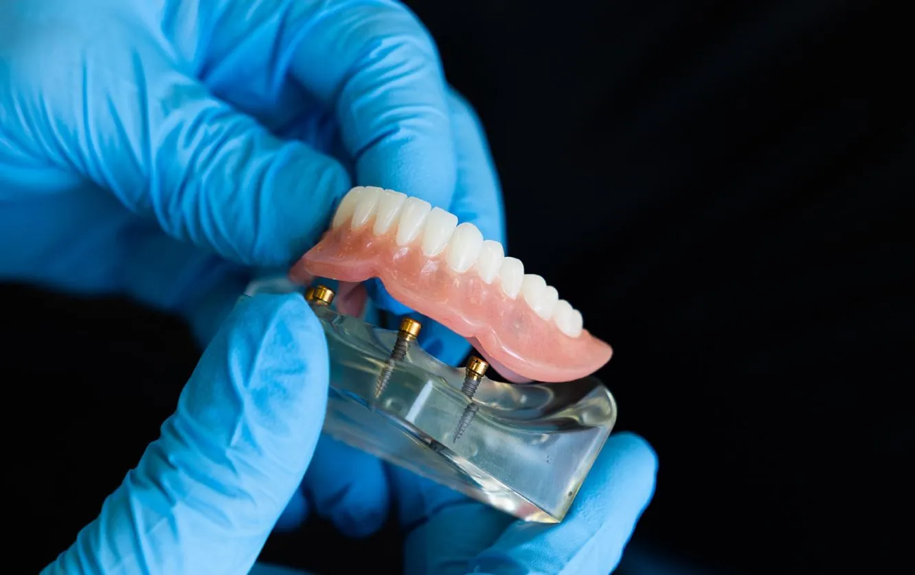 Gloved hands fitting a clear dental aligner onto a plaster model of teeth, demonstrating the step-by-step process of clear aligner therapy for orthodontic treatment