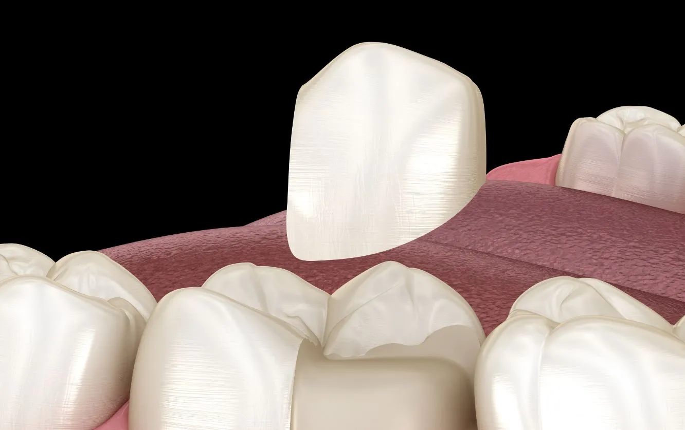 Close-up of a row of white porcelain dental crowns arranged on a black background, showcasing restorative solutions for damaged or missing teeth