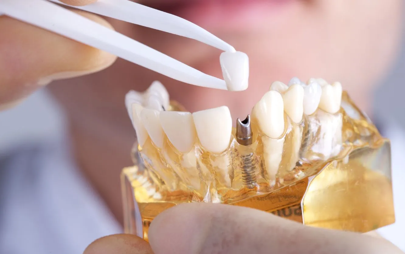 Pair of gloved hands presenting a large golden anatomical molar model with visible pulp and root structure, symbolizing advanced dental procedures such as root canal therapy or tooth replacement using dental implants