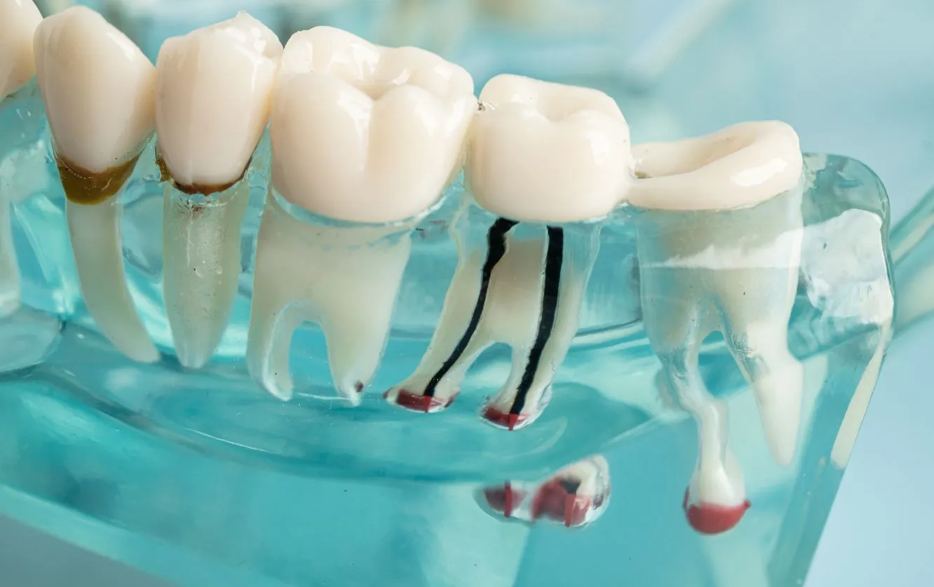 Detailed close-up of dental implant posts anchored in a translucent jaw model, showcasing realistic artificial teeth for patient education on implant procedures