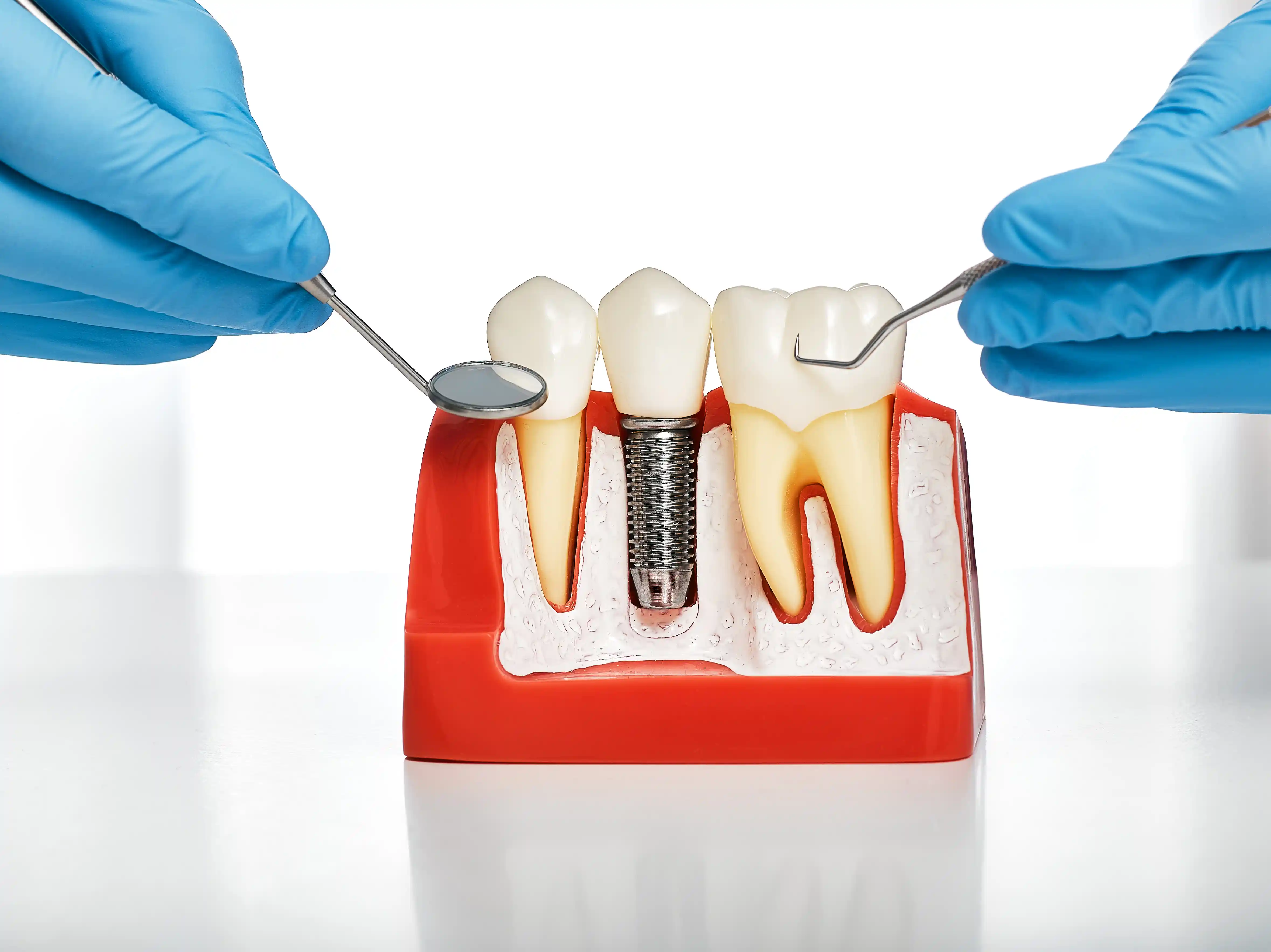 Anatomical dental model showing tooth roots and gum structure used for educating patients about root canals, gum disease, and oral health at a leading dentist office near me in Lathrup Village