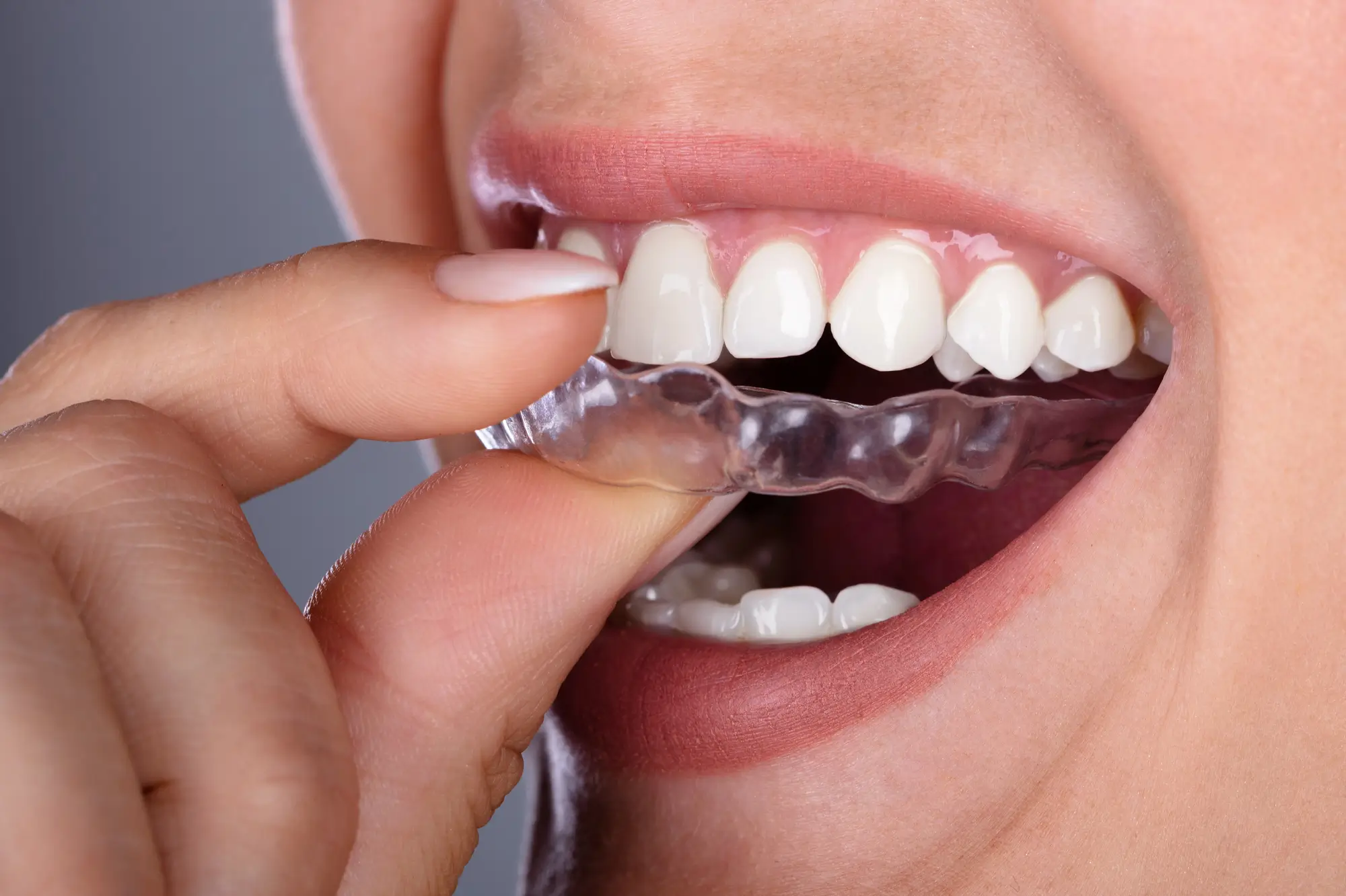 Patient putting transparent aligner, orthodontist Sumter SC