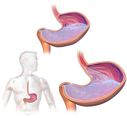 stomach acid flows back up the esophagus with gerd