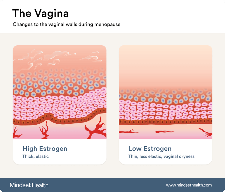 A diagram of the vaginal walls becoming less elastic in menopause