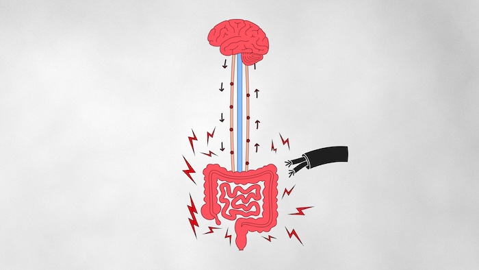 Illustration of gut-brain signaling showing how food triggers amplified nerve responses and abdominal pain in gut-brain disorders like IBS