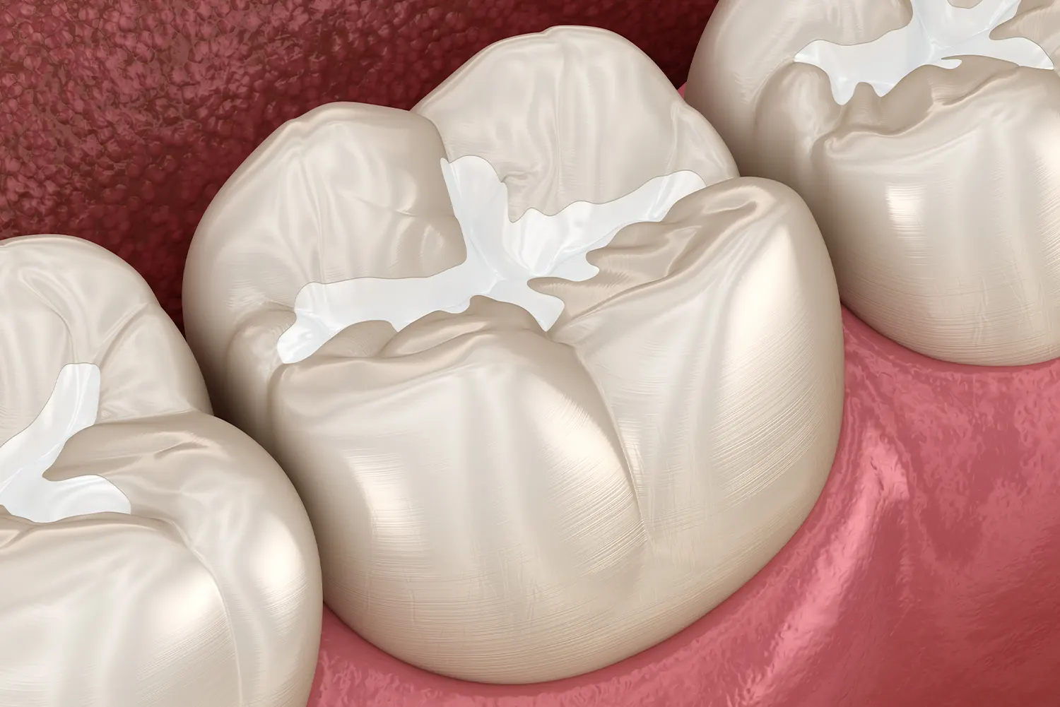 Introducing a child to the dental sealant process at Polished Pediatric Dentistry
