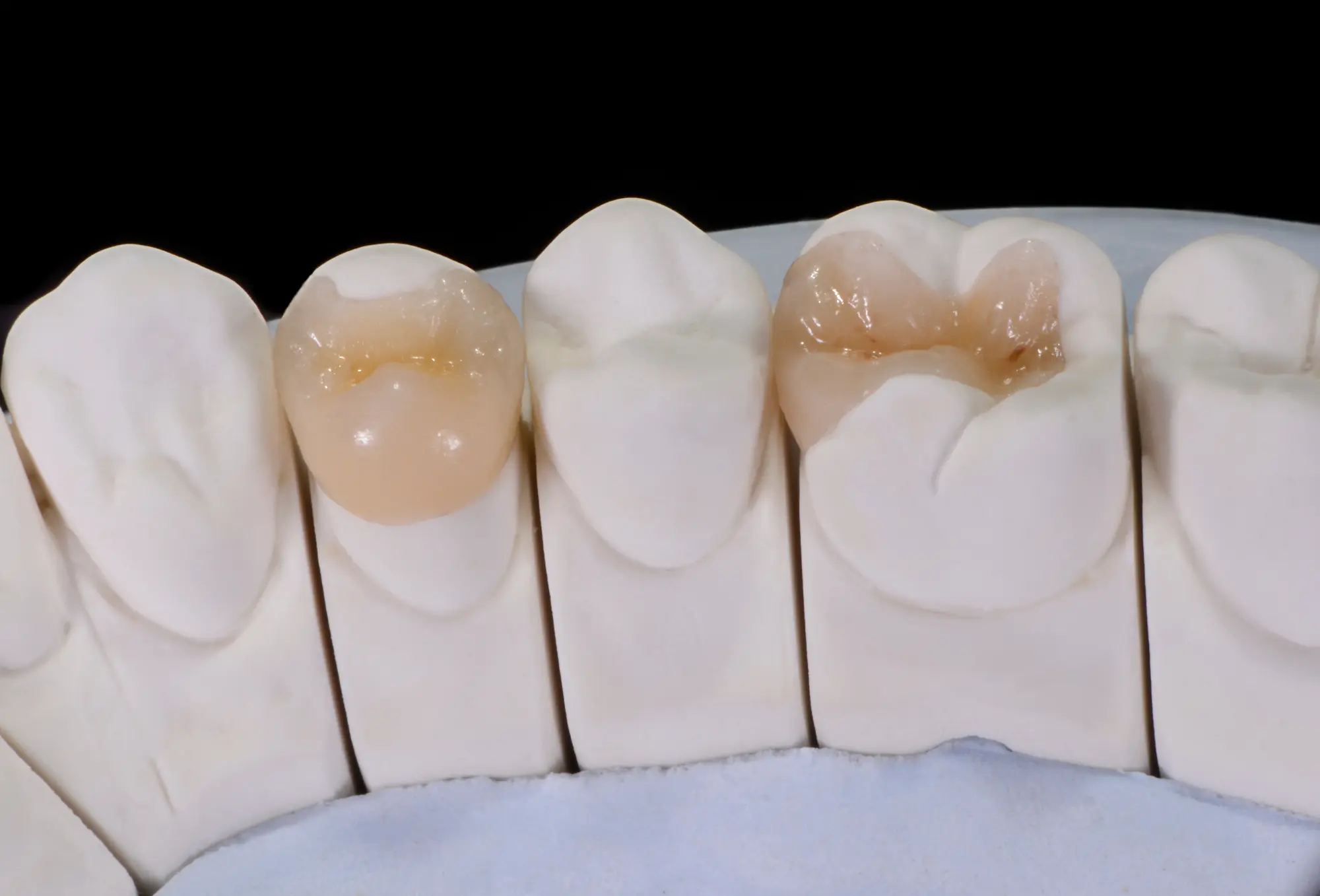 Child smiling after a healthy composite filling treatment