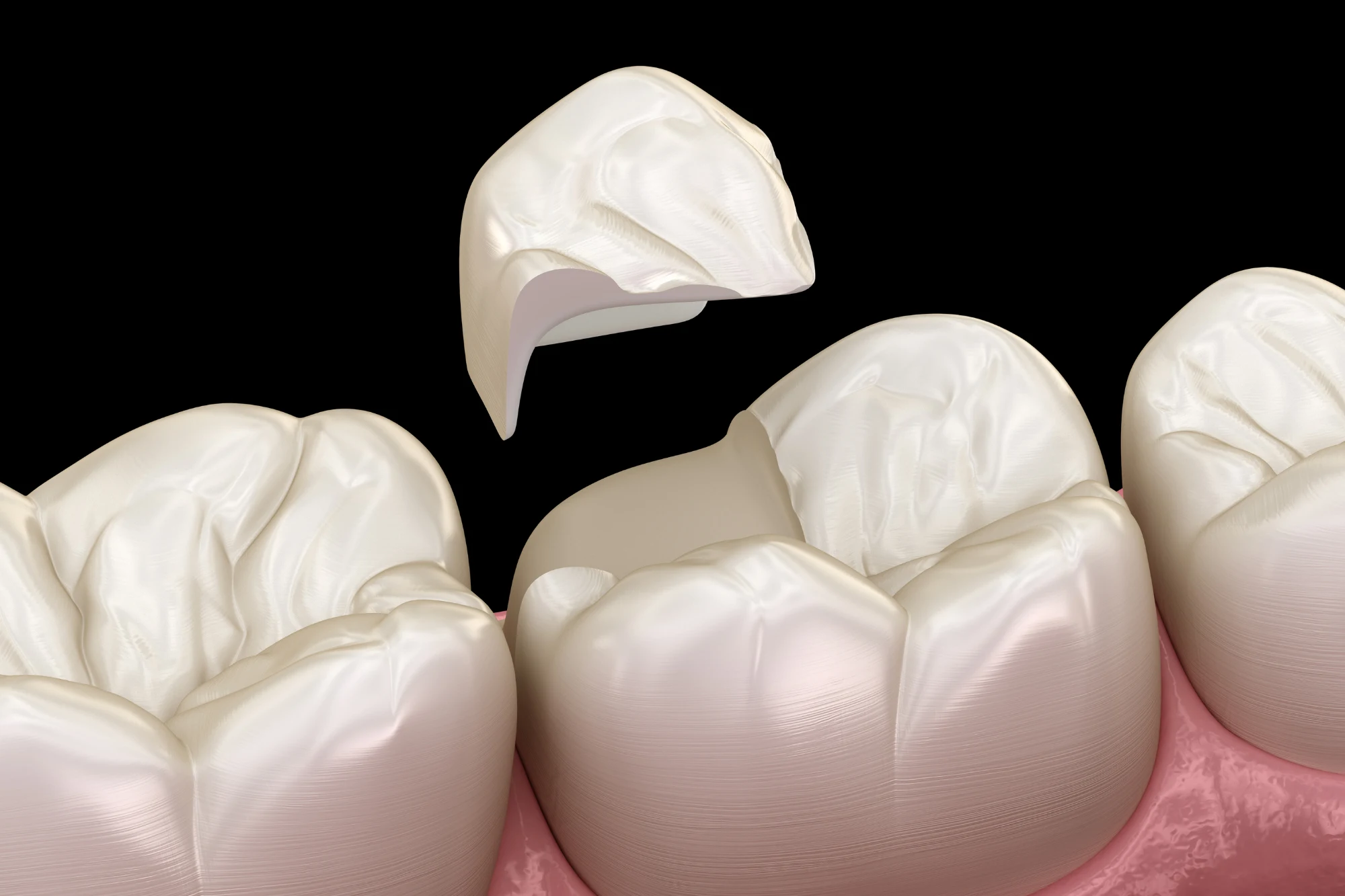 Dental sealant applied to a child's molar for cavity protection
