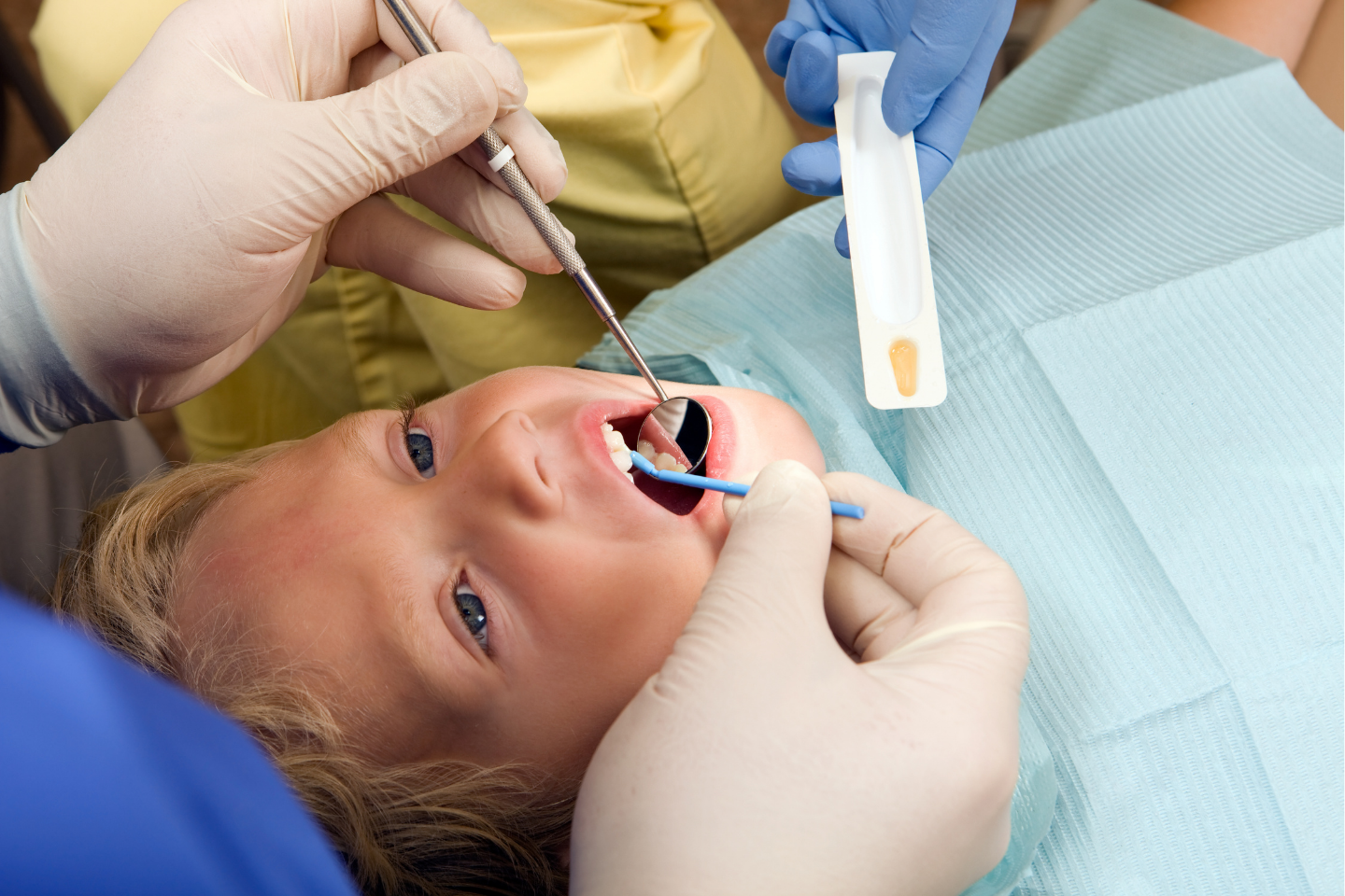 Child's tooth enamel restoration treatment