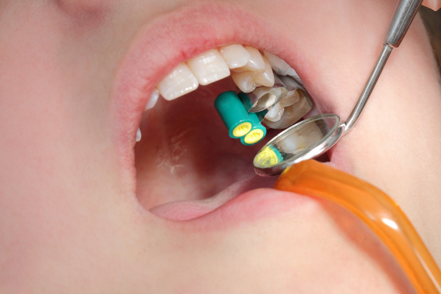 Cavity filling procedure being performed on a child's tooth