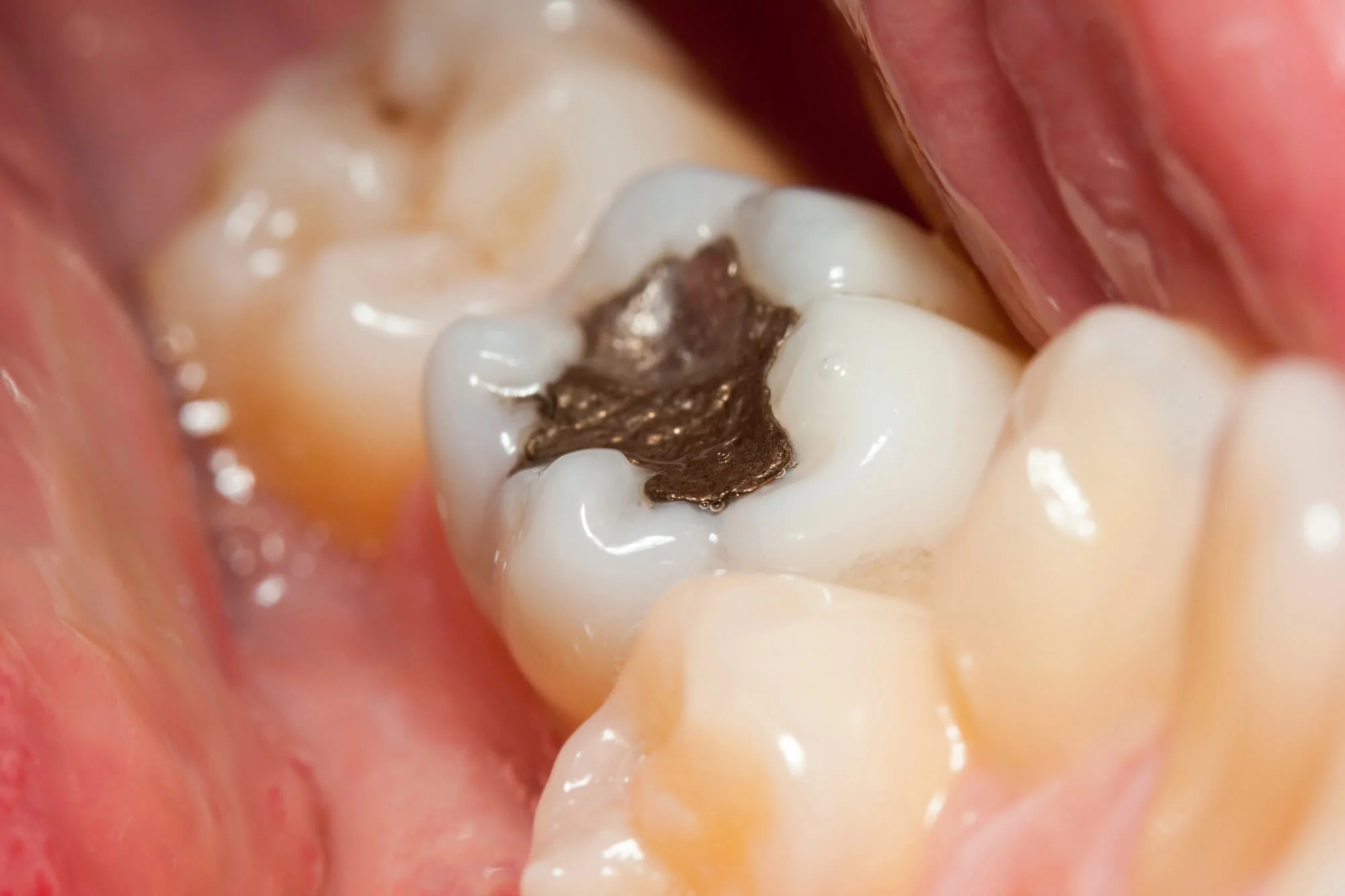 Old metal filling before mercury filling removal.