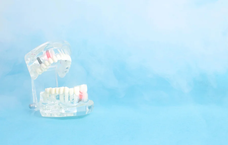 ozone-therapy-dental-implant-model-highlighted-tooth