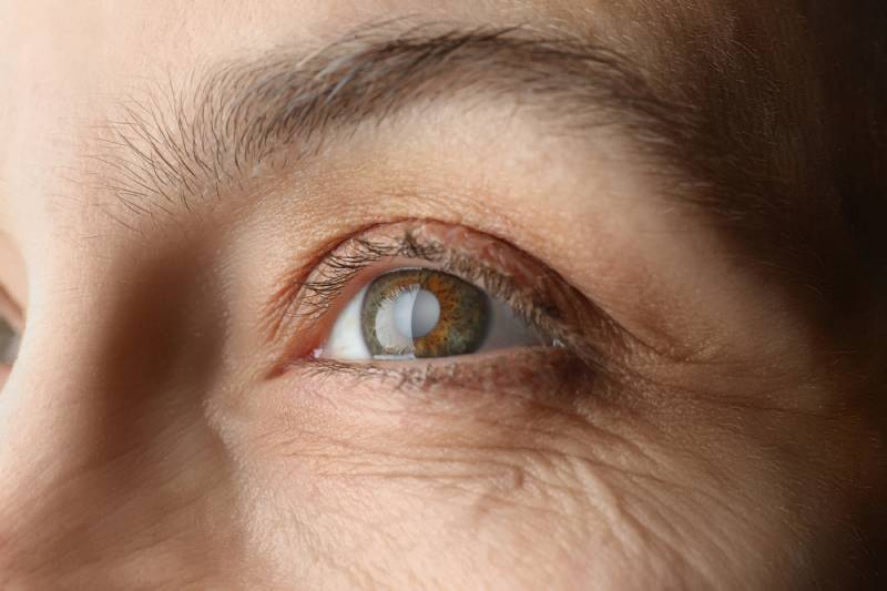 Close-up of human eye with cataract