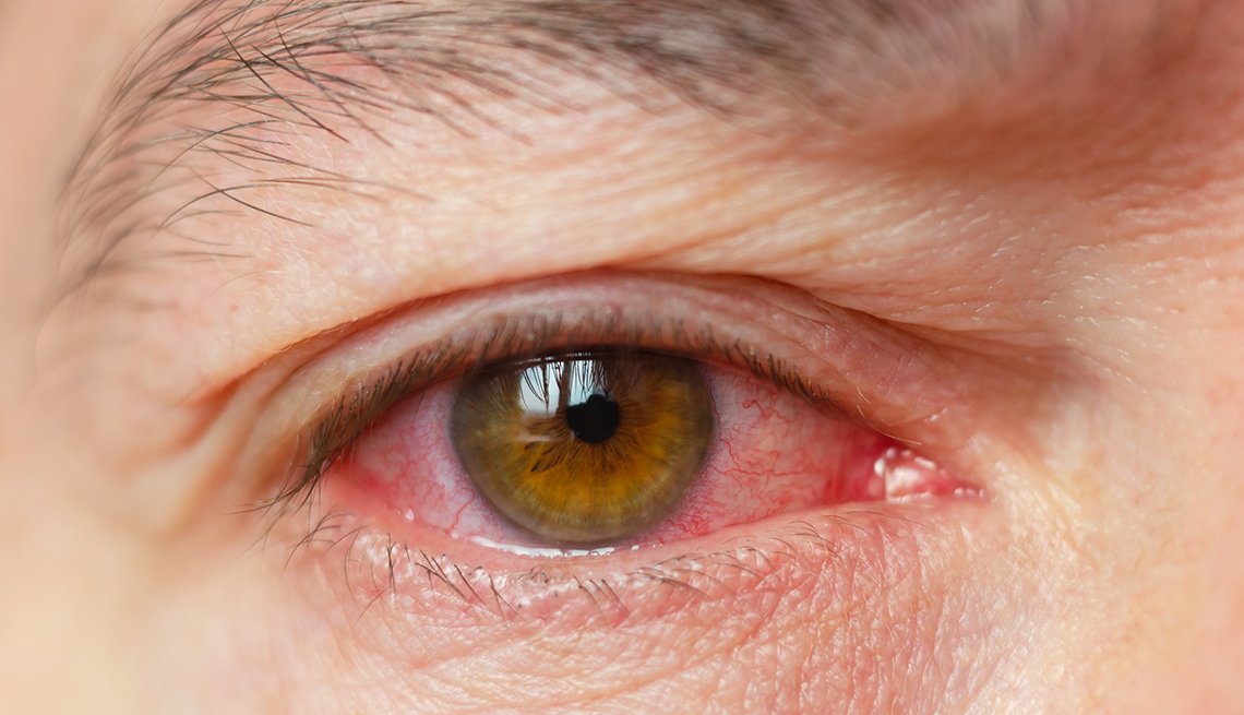 Close-up of irritated red eye