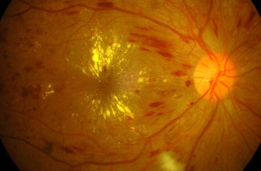 Fundus photo showing diabetic retinopathy