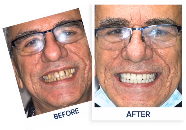 before-after-teeth