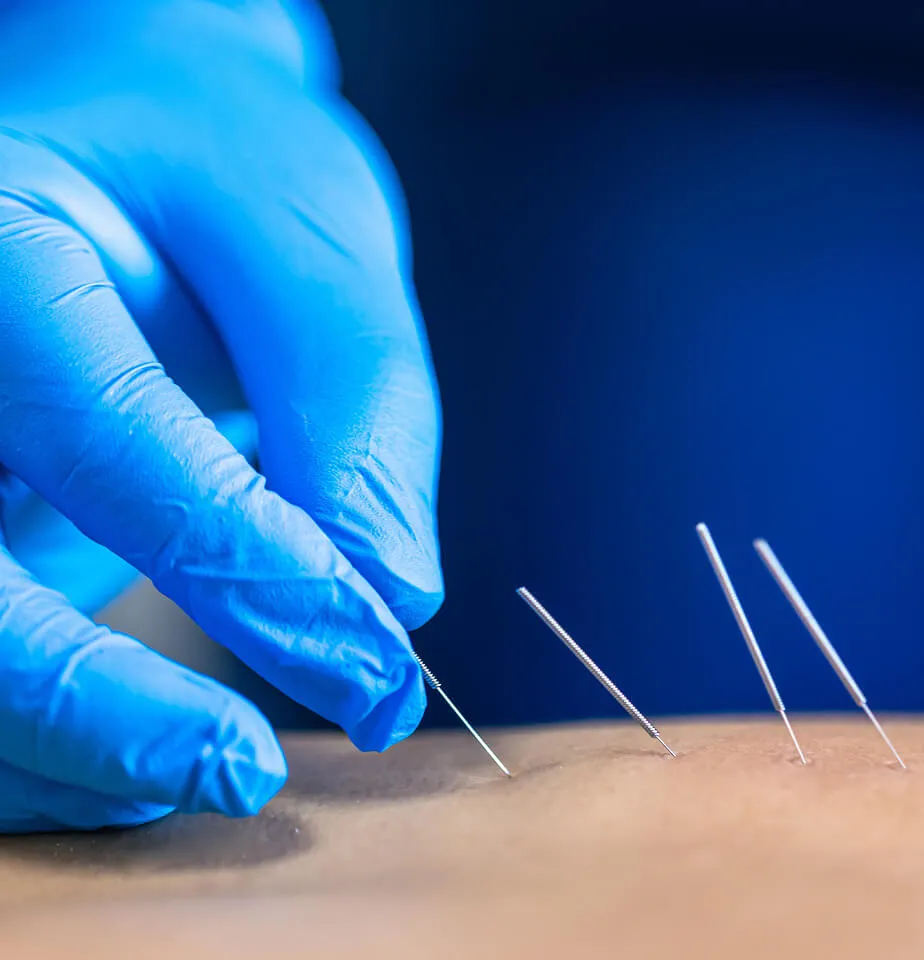 dry needling close up - hero