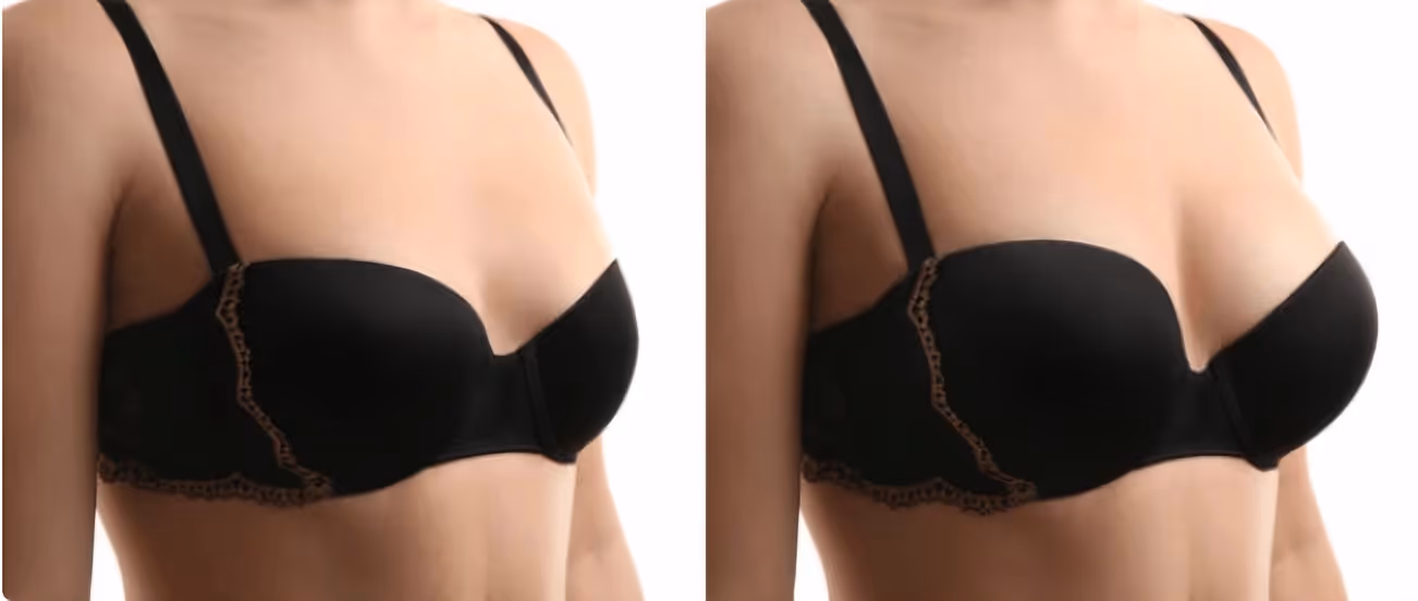Before and after breast augmentation with fat transfer. The breasts appear fuller and more rounded, with a subtle, natural-looking increase in volume. This technique uses the patient’s own fat to enhance shape without implants.
