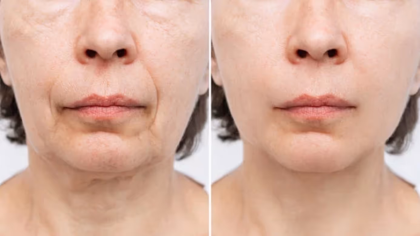 SMAS Facelift before and after