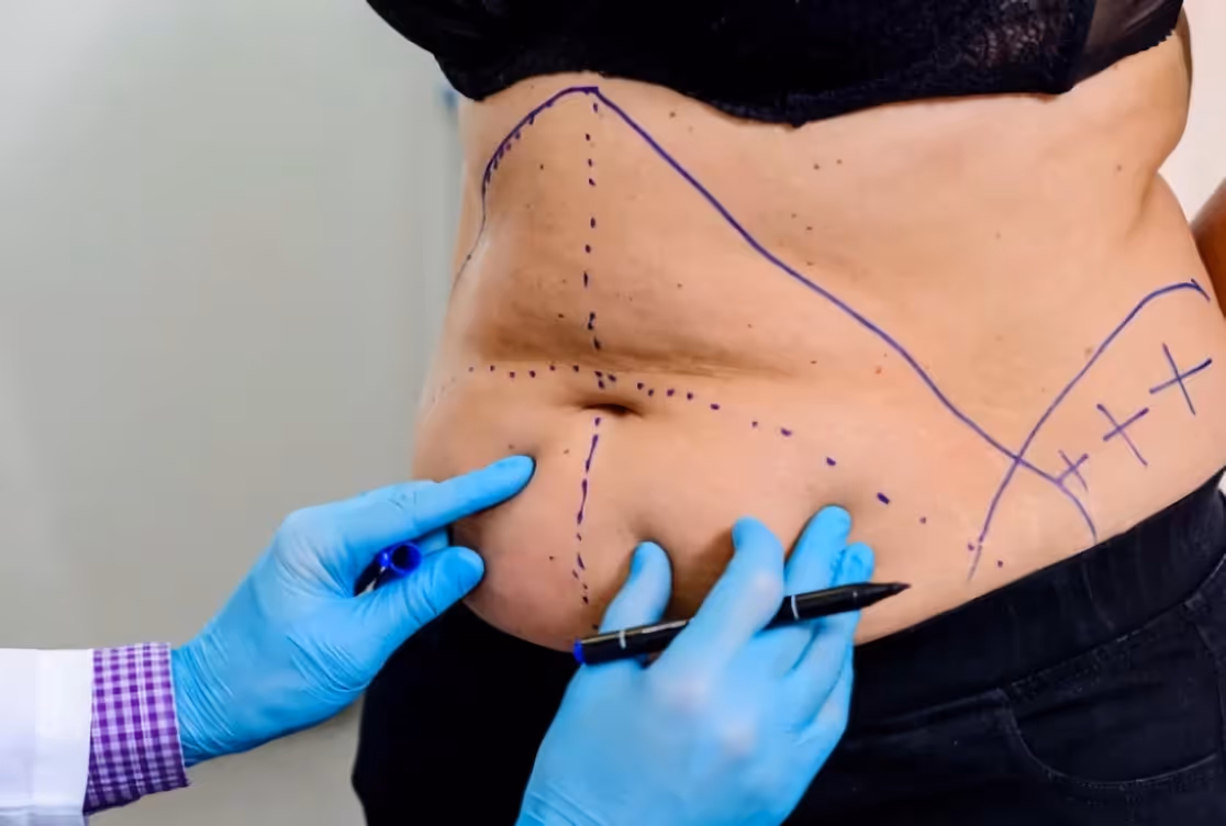 Pre-operative markings for an abdominoplasty in Belgium, mapping the skin to be removed and areas to be contoured for a smoother waistline.