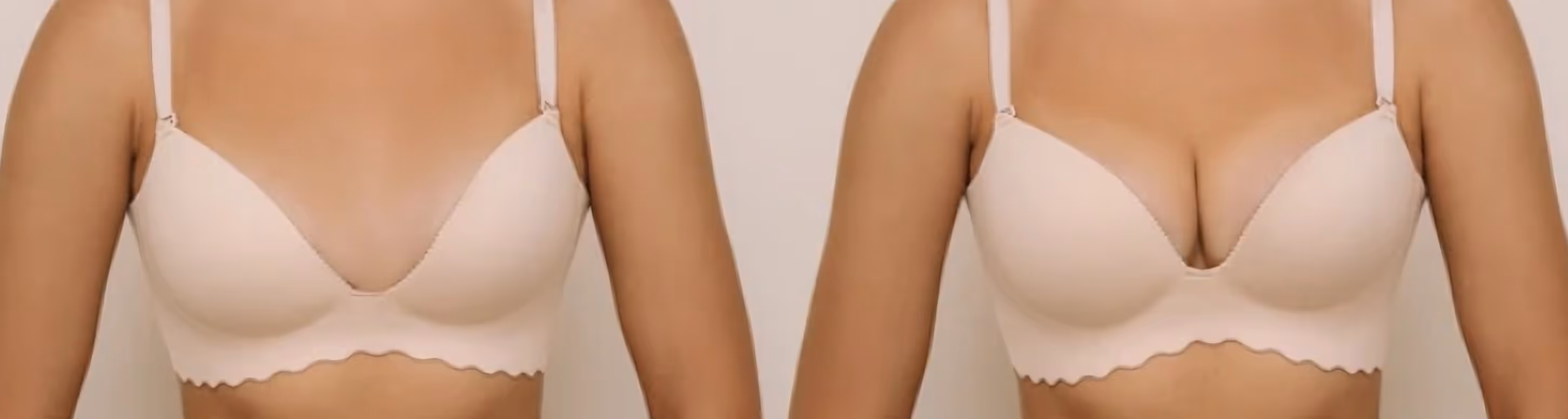 Breast Augmentation
