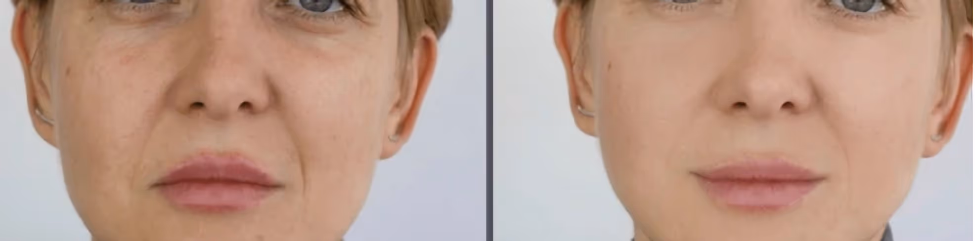 Before and after full-face fat grafting. Restored volume in the cheeks, nasolabial folds, and under-eye area creates a softer, more youthful look. Fine lines are diminished, and facial contours appear smoother and more balanced.