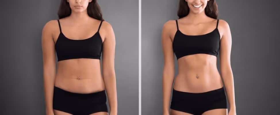 Before and after Lipo 360 with arm liposuction. The treatment refined the waist, abdomen, flanks, and upper arms, creating a more sculpted, balanced silhouette with enhanced definition through the torso and arms.