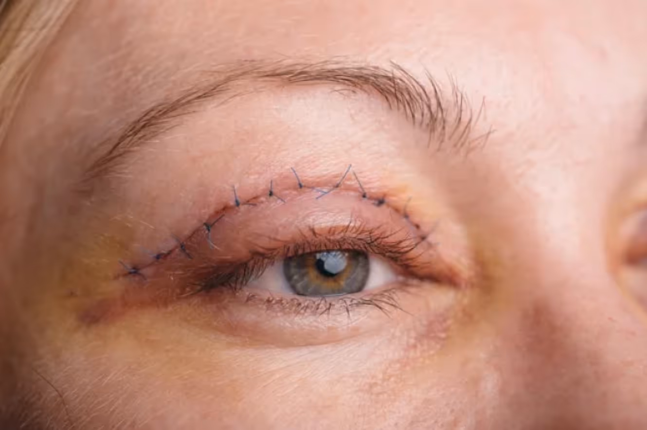 Upper blepharoplasty. Early Healing Stage. Day 1–7 post-op.