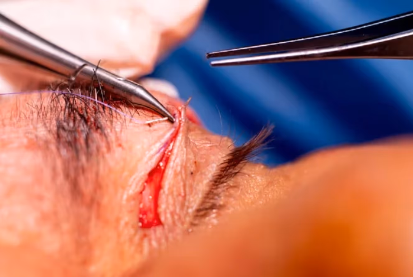 Intraoperative View ‍Upper blepharoplasty in progress.