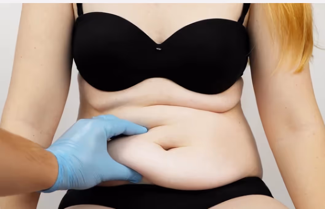 A plastic surgeon evaluates excess skin and fat during a tummy tuck consultation in Belgium, checking how much can be safely removed.
