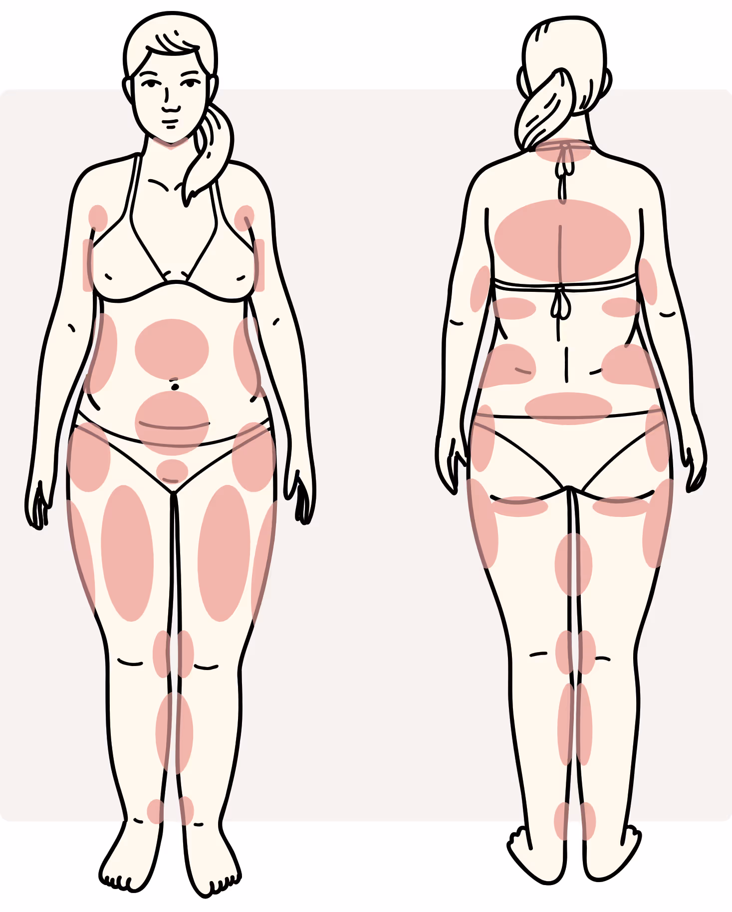 Liposuction zones