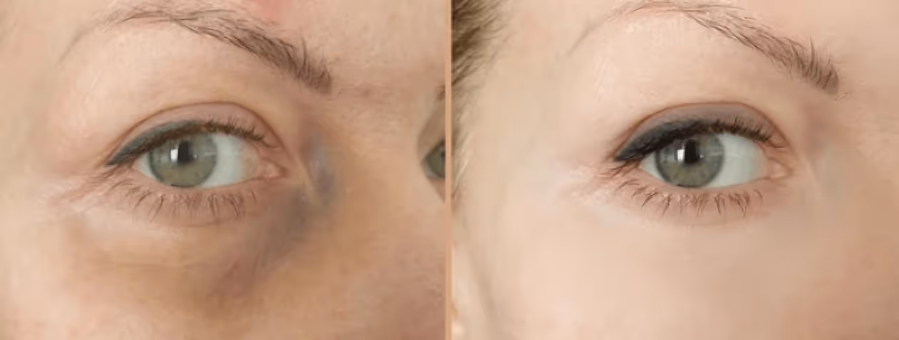 Before and after facial fat grafting to the under-eye area. Volume restoration reduced tear trough hollowing and shadowing, creating a smoother, more rested appearance.
