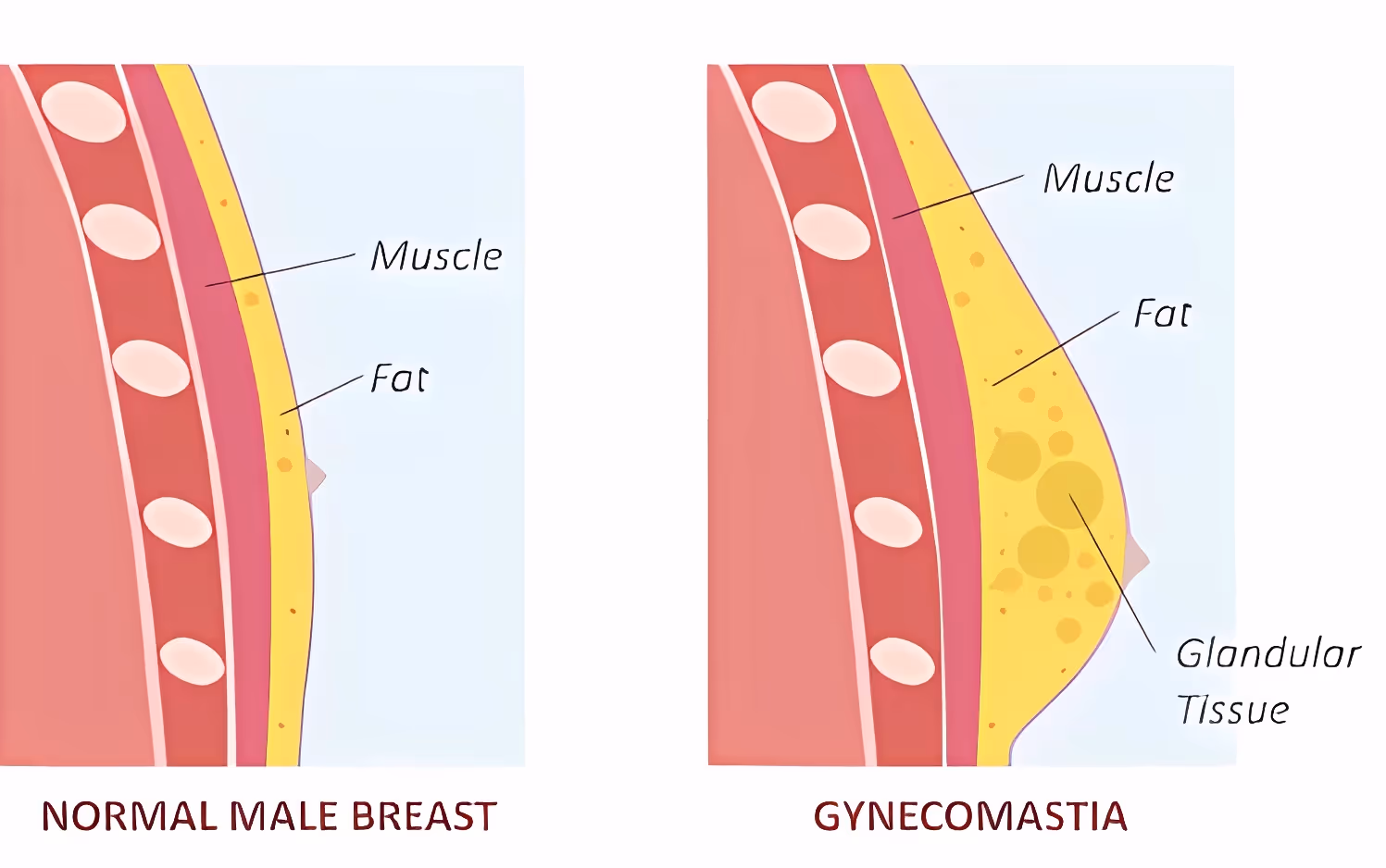 Gynaecomastie vs. normale mannelijke borst