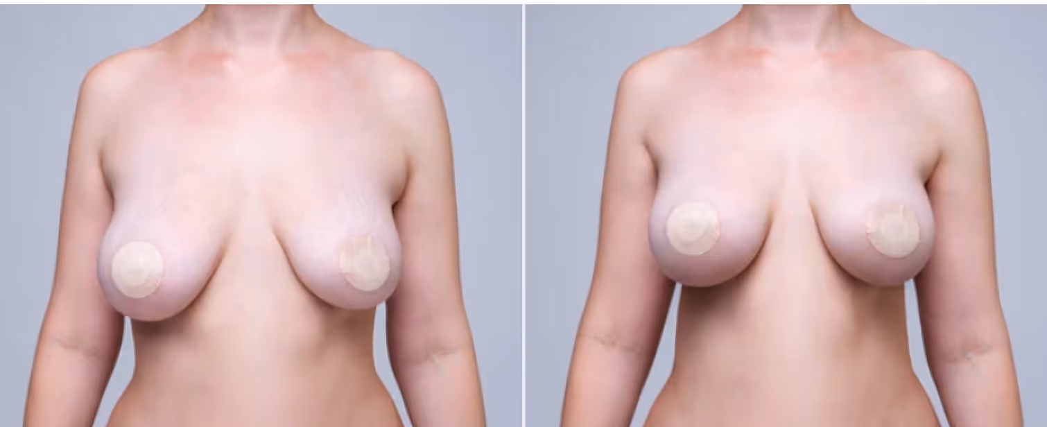 Before and after breast lift (mastopexy). 