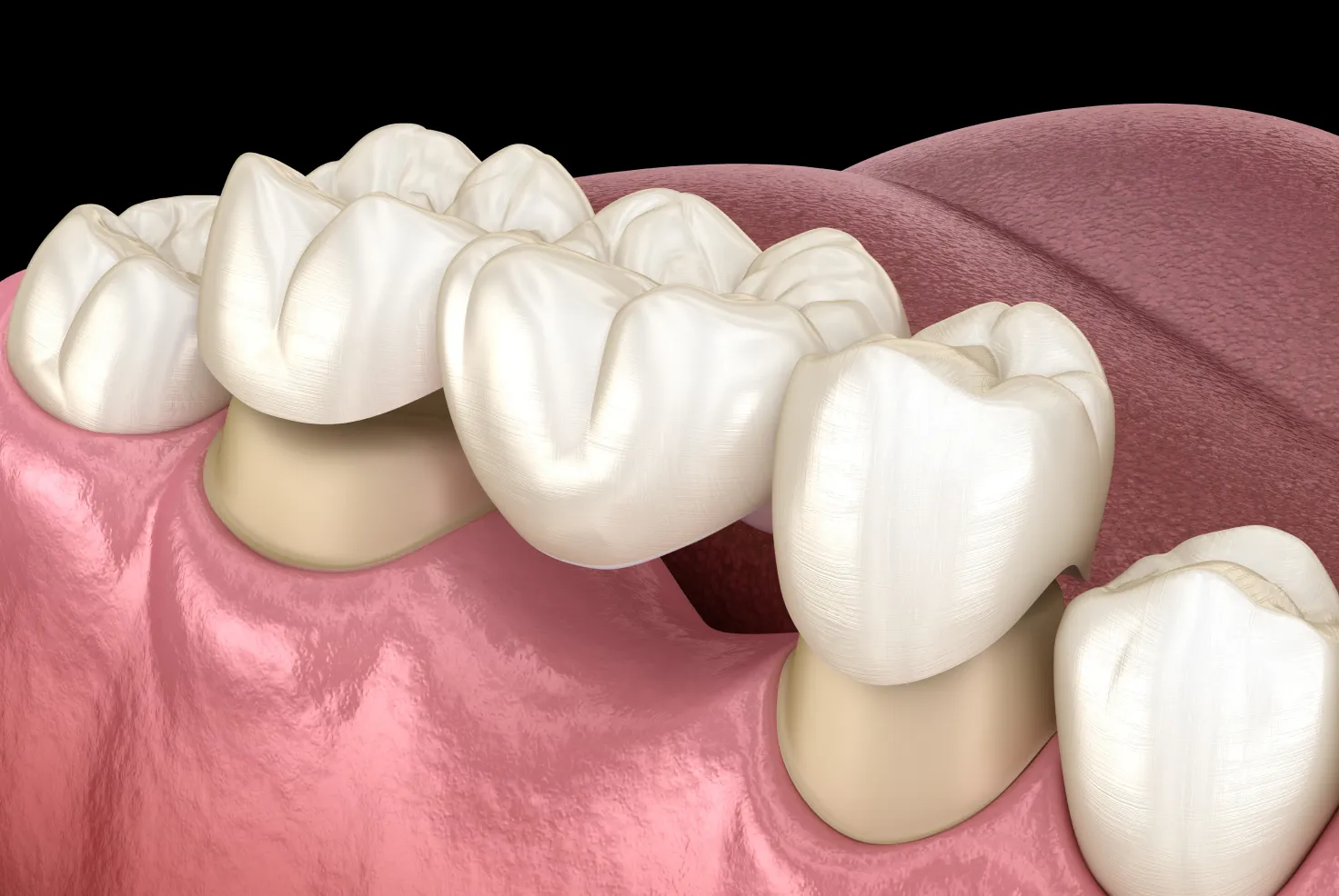 Dental Bridges in Alliston, ON