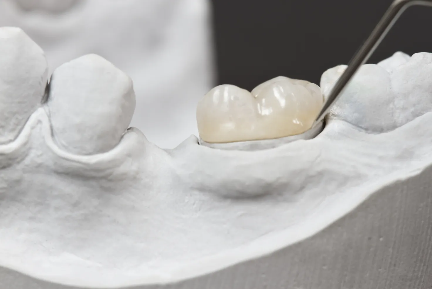 Dental Inlays & Onlays in Alliston, ON