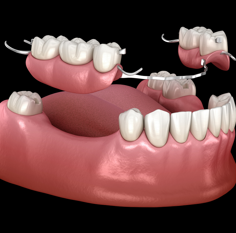Types of Partial Dentures