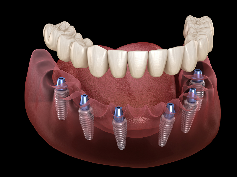 Why Choose Issaquah Dentists for Implant-Supported Dentures?