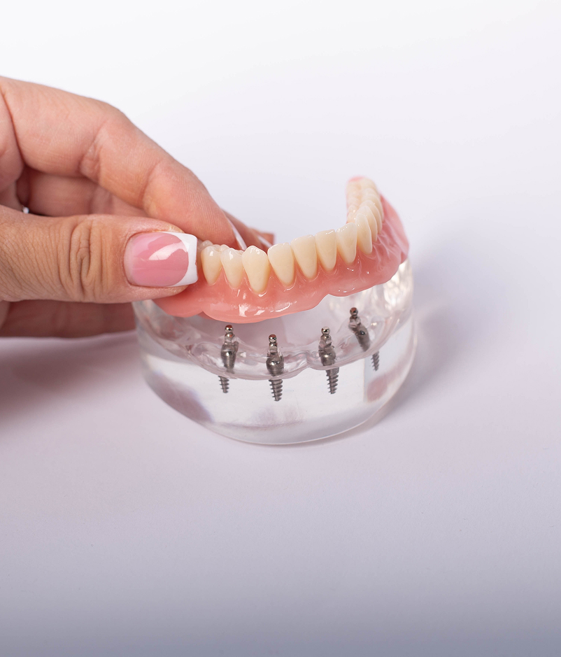 Benefits of Implant-Supported Dentures