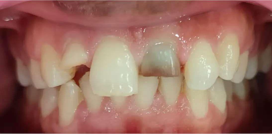 Zirconia crown Before