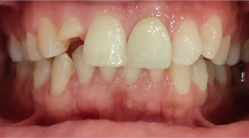 Zirconia Crown After