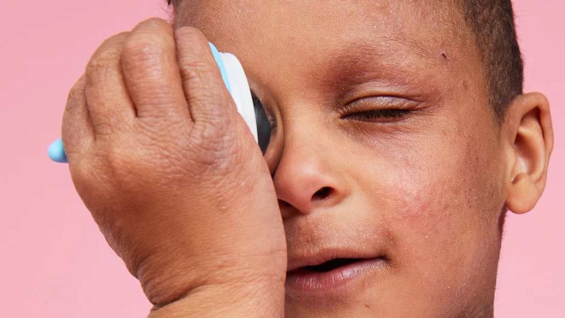 A young boy with a scar on his face is looking at a mirror.