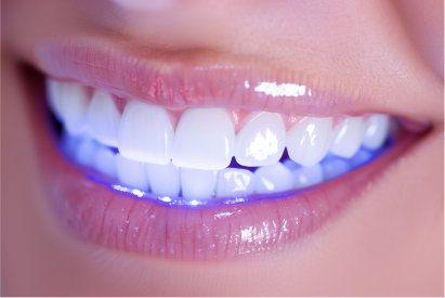 Professional Teeth Whitening vs. At-Home Kits: Which Is Right for You?
