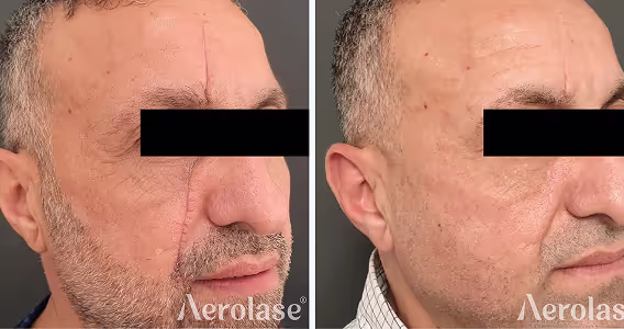 A before and after picture of a man's hair transplant