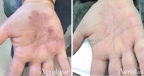 A hand with a lot of white marks on it