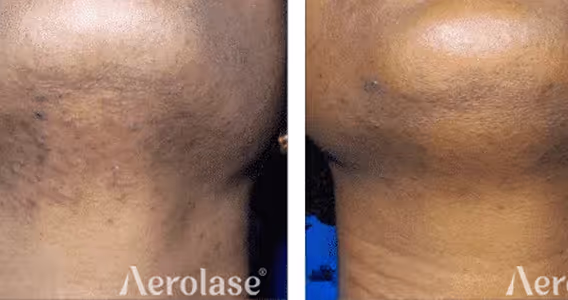 A before and after picture of a woman's neck
