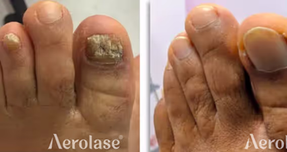 A before and after picture of a person's toe