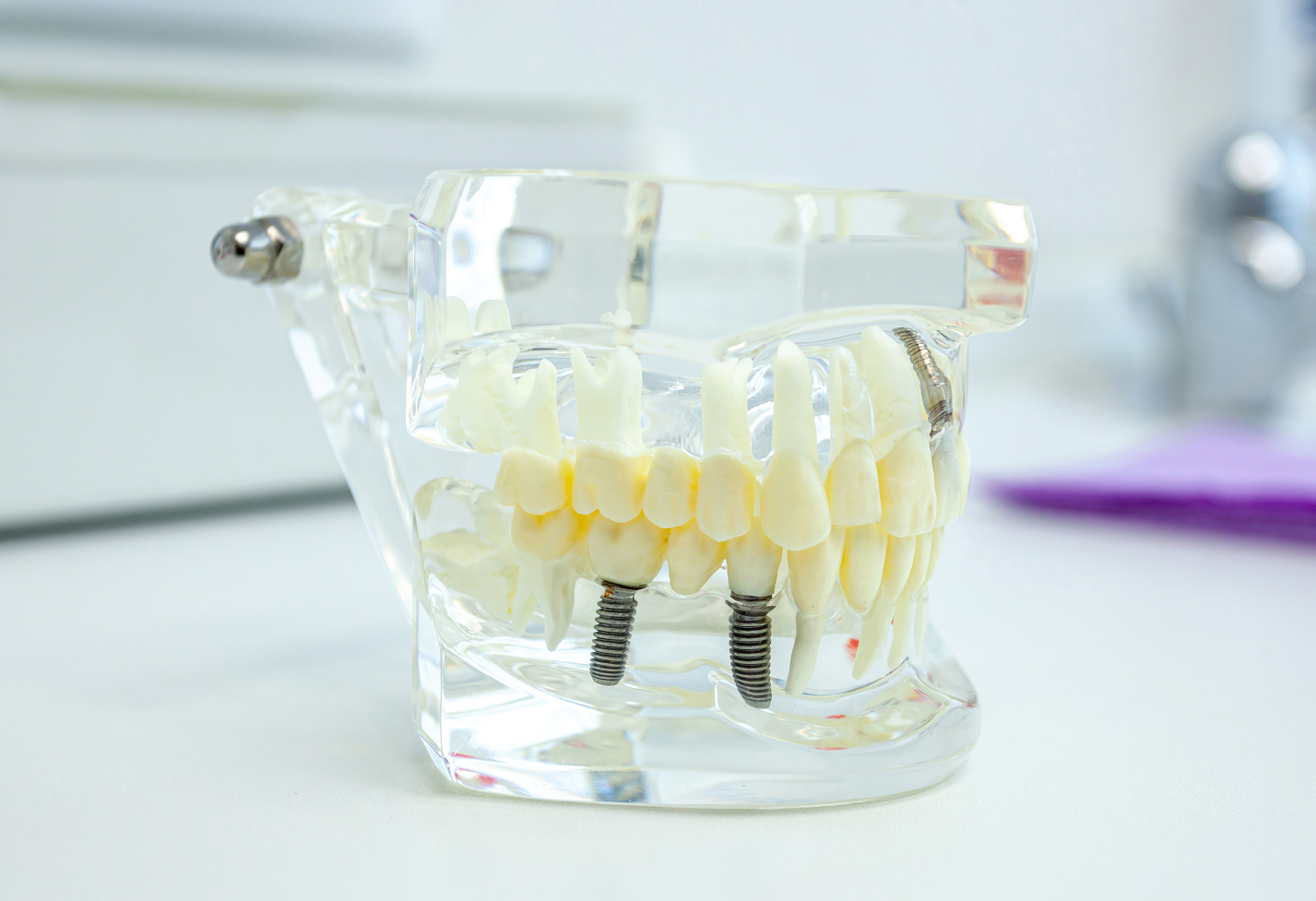 Close-up of a dental implant model showing artificial teeth and titanium posts.