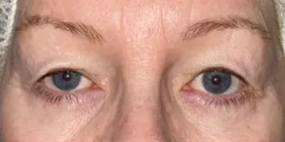 Before Bilateral upper eyelid blepharoplastywith right upper eyelid repositioning